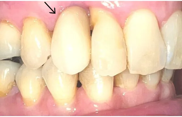 50代女性のインプラント（歯1本分）：治療後