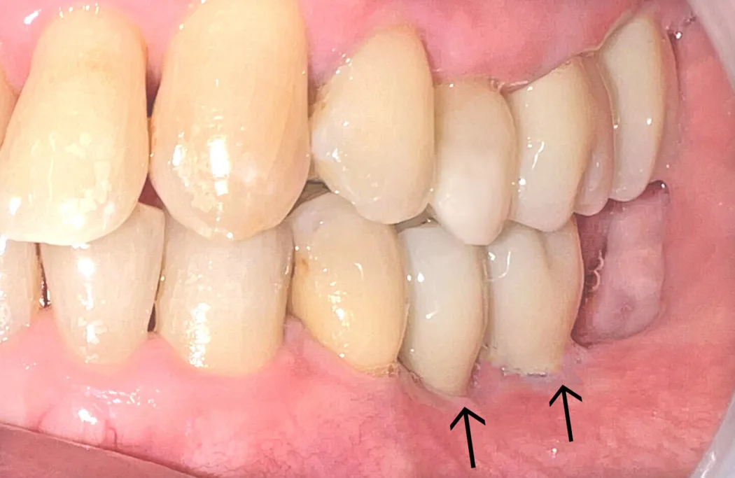 50代男性のインプラント（歯2本分）：治療後